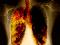 Lungcancer